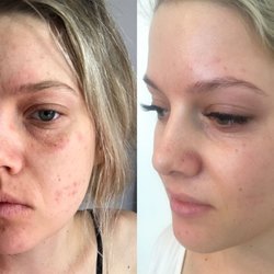 Successful treatment of eczema, acne and dehydration using advanced treatments including chemical peels, silk peels and micro-needling.