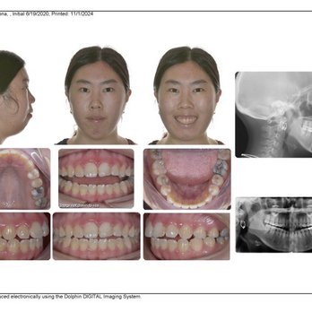 Vivian Lee Orthodontics - Before photos: Summer 2020 - Orthodontists Near Me - Arcadia, California Vivian Lee Orthodontics - Before photos: Summer 2020 - Orthodontists Near Me - Arcadia, California