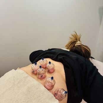 REO - Cupping - Physical Therapy Near Me - Pasadena, California REO - Cupping - Physical Therapy Near Me - Pasadena, California