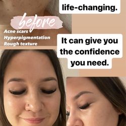 Skincare Maui - SQT Biomicroneedling treatment