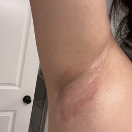 A day after armpit waxing