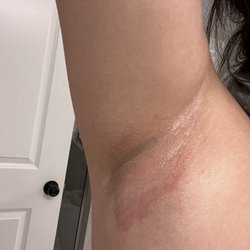 SILK Threading & Wax Salon - A day after armpit waxing