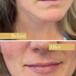 Boon Therapeutics - Natural Lip enhancement with filler.