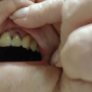 Allen Smile Design - My gums have started going black after regular visits to Allen Smile Design. - General Dentistry Near Me - Allen, Texas