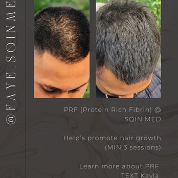 SQIN MED - PRF Hair Restoration - Medical Spas Near Me - Niagara Falls, Ontario SQIN MED - PRF Hair Restoration - Medical Spas Near Me - Niagara Falls, Ontario
