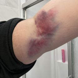 Labcorp - Bruise