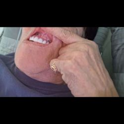 Dental Implant Center of Coral Springs, FL - Screws exposed showing and hurting