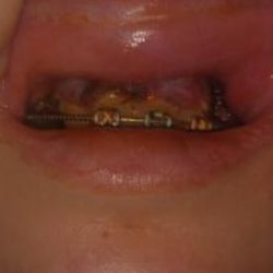BZG Oral And Maxillofacial Surgery Center - He cut her gums along the gum line.