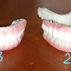 Front Range Dentures and Prosthodontics - 1) Dr. Soter's 1st, 2) Dr. Soter's 2nd (not delivered to me). 3) Dr. Kostas unknown take over, moved case to CO. 4) Dr. Kostas final set.