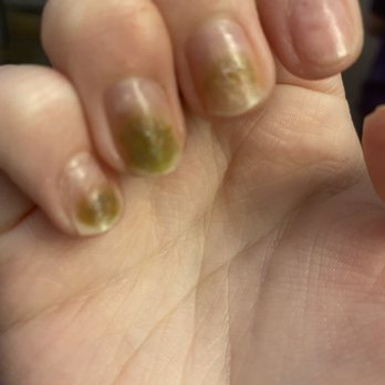 Princess Nails Peoria - infected nails - Nail Salons Near Me - Peoria, Illinois