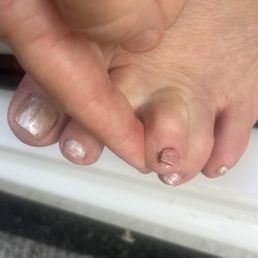 Toe injury