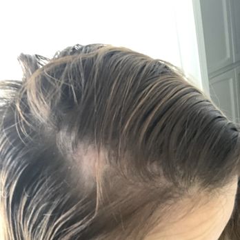 DKW Styling Salon - Bald spots after removal - Hair Extensions Near Me - Laguna Beach, California DKW Styling Salon - Bald spots after removal - Hair Extensions Near Me - Laguna Beach, California