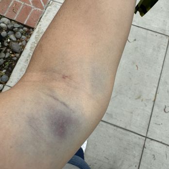 Biolife Plasma Services - Bruising the day following - Blood & Plasma Donation Centers Near Me - Lemon Grove, California