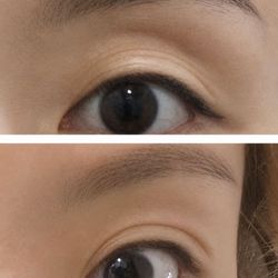 Dling Medical Aesthetic Center - One-time PRF upper lids-eye hollow treatment -- two weeks immediate result