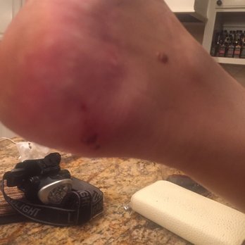 SP Nail Spa - Acetone burn - Nail Salons Near Me - Tustin, California SP Nail Spa - Acetone burn - Nail Salons Near Me - Tustin, California