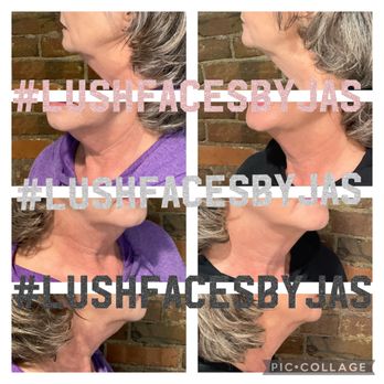 ERA Wellness Spa - Kybella Treatment at Lush Aesthetics - Medical Spas Near Me - Georgetown, Kentucky