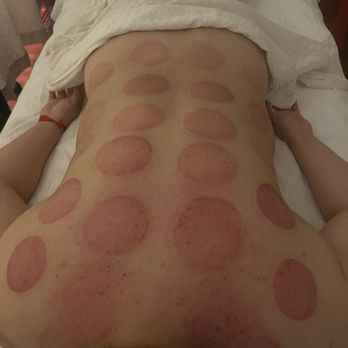 Xinhe Natural Acupuncture PC - Cupping marks - Acupuncture Near Me - Elmhurst, New York Xinhe Natural Acupuncture PC - Cupping marks - Acupuncture Near Me - Elmhurst, New York