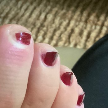 Twinkle Nail Bar - Infected toe and and toenails cut at an angle - this also causing ingrown toenails! - Nail Salons Near Me - Cypress, Texas Twinkle Nail Bar - Infected toe and and toenails cut at an angle - this also causing ingrown toenails! - Nail Salons Near Me - Cypress, Texas