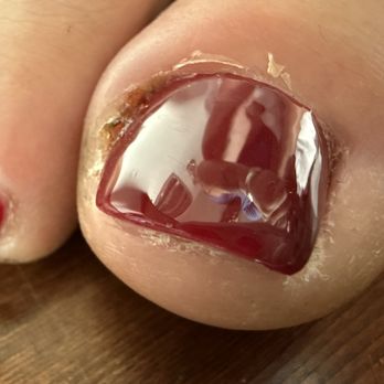 Vip Nails & Spa - I'm not sure what could've done differently, but as you can see, it's quite infected and extremely sore - Nail Salons Near Me - Anchorage, Alaska Vip Nails & Spa - I'm not sure what could've done differently, but as you can see, it's quite infected and extremely sore - Nail Salons Near Me - Anchorage, Alaska