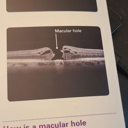 Gian Paolo Giuliari, MD - What a macular hole looks like.