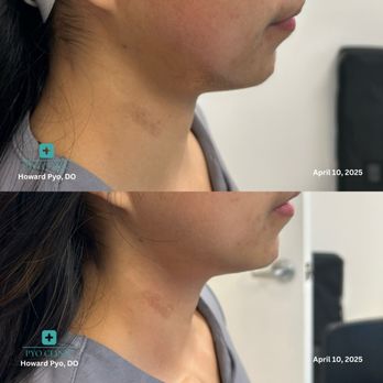 Pyo Clinic - After 1 Session of Diamond Polar for Neck, Immediate Result - Preventive Medicine Near Me - Fullerton, California Pyo Clinic - After 1 Session of Diamond Polar for Neck, Immediate Result - Preventive Medicine Near Me - Fullerton, California