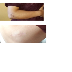 Lifespan Physical Therapy - Elbow before and after treatment