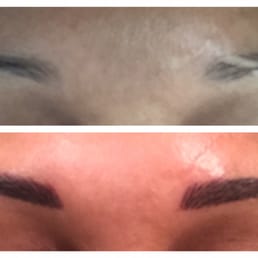 Before and immediately after the procedure. The color and strokes softened as it healed over the next 4-5 days. Before and immediately after the procedure. The color and strokes softened as it healed over the next 4-5 days.