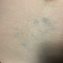 Jin De Foot Spa - Bruises all on my lower back where I kept telling him he was being too rough