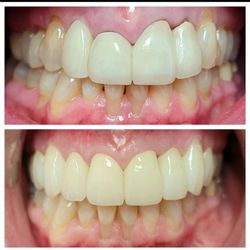 Fakhoury, Nicolas W DMD - Upper New Crowns with gum tissue Scalloping.