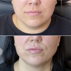 Skin & Beauty Bar - 1 year post lip Juvéderm treatment.