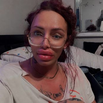 Beauty Me MD - Bad lip injections - Medical Spas Near Me - Los Angeles, California