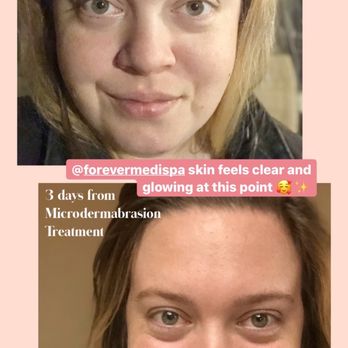 Forever Young Medi Spas - Progress and results - Medical Spas Near Me - Sugar Land, Texas Forever Young Medi Spas - Progress and results - Medical Spas Near Me - Sugar Land, Texas