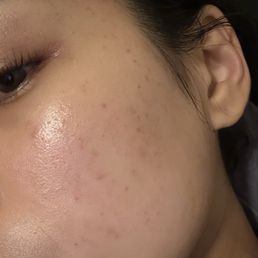 After -- no make up After -- no make up