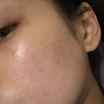 Skin Bar by Mila - After -- no make up - Skin Care Near Me - Long Beach, California Skin Bar by Mila - After -- no make up - Skin Care Near Me - Long Beach, California
