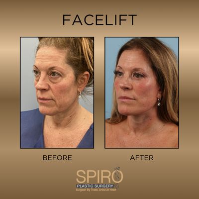 SCOTT A SPIRO, MD FACS - SPIRO PLASTIC SURGERY - Updated April 2026 ...