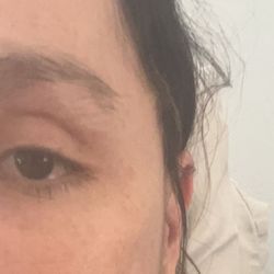 David L Abramson,MD - Slanted eyes