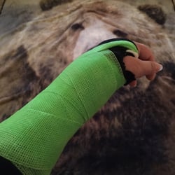 Sutter Amador Orthopedics - Got in fight with s bear
