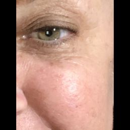 After 1-Laser treatment and 8 days healing it's gone