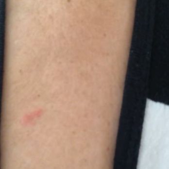 Vacasa - Big Bear Lake - Bed bugs bites - Vacation Rentals Near Me - Big Bear Lake, California