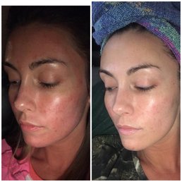 No filter Results from only one session of microneedling!!! No filter Results from only one session of microneedling!!!
