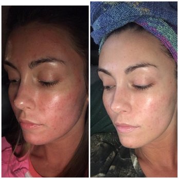 Spa Three Ten - No filter Results from only one session of microneedling!!! - Hair Salons Near Me - Richmond, Virginia Spa Three Ten - No filter Results from only one session of microneedling!!! - Hair Salons Near Me - Richmond, Virginia