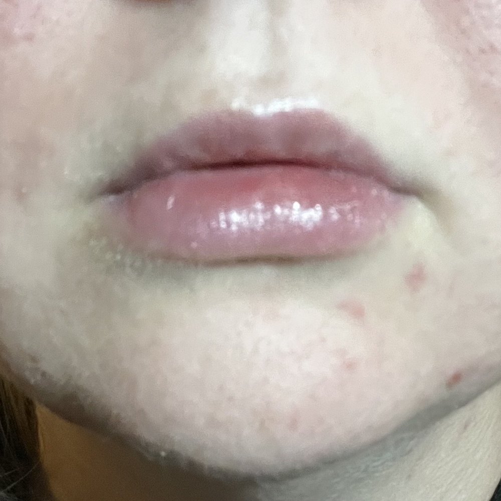 Glowhaus - after 1.5 weeks - Medical Spas Near Me - Denver, Colorado Glowhaus - after 1.5 weeks - Medical Spas Near Me - Denver, Colorado