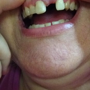 Arpit Mody, DDS - To big of caps again by Doctor mody . - Cosmetic Dentists Near Me - Warren, Michigan Arpit Mody, DDS - To big of caps again by Doctor mody . - Cosmetic Dentists Near Me - Warren, Michigan