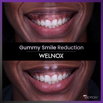 WELNOX Studio - Gummy Smile Reduction - General Dentistry Near Me - Philadelphia, Pennsylvania WELNOX Studio - Gummy Smile Reduction - General Dentistry Near Me - Philadelphia, Pennsylvania