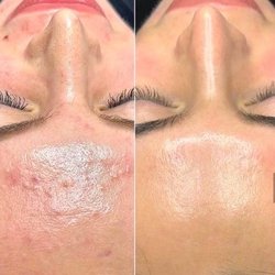 The Laser Beauty Spot - The esthetician is very knowledgeable to work with all acne an saw great results .
