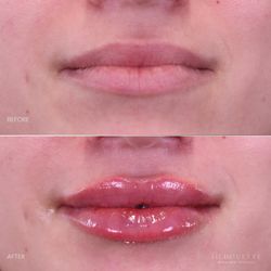Silhouette Aesthetics - Lip Filler