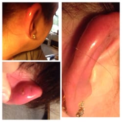 Claire's Boutiques - Infection. Hurts like heck. Looks gross too. Hopefully antibiotics will kick in soon!