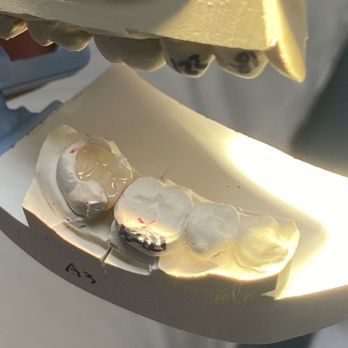 Elements Dentistry - 31 MO Zirconia inlay - General Dentistry Near Me - Pico Rivera, California Elements Dentistry - 31 MO Zirconia inlay - General Dentistry Near Me - Pico Rivera, California