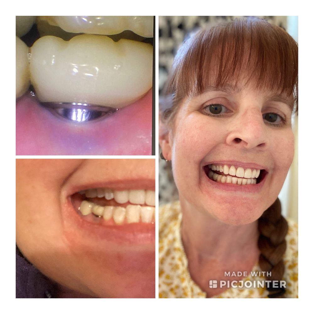 Michael A Piccione, DDS - Before on the left. New crown and happy patient on right. - Cosmetic Dentists Near Me - Petaluma, California Michael A Piccione, DDS - Before on the left. New crown and happy patient on right. - Cosmetic Dentists Near Me - Petaluma, California