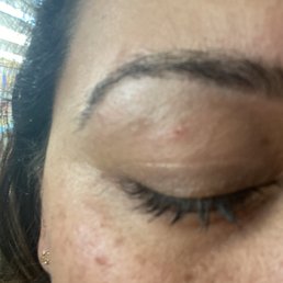I have Cuts on both my eye lids